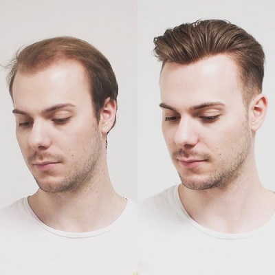 How-Effective-Are-Non-Surgical-Hair-Replacement-and-Hair-Transplant