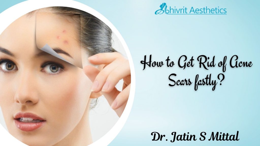 How to Get Rid of Acne Scars fastly? @Dr. Jatin S Mittal